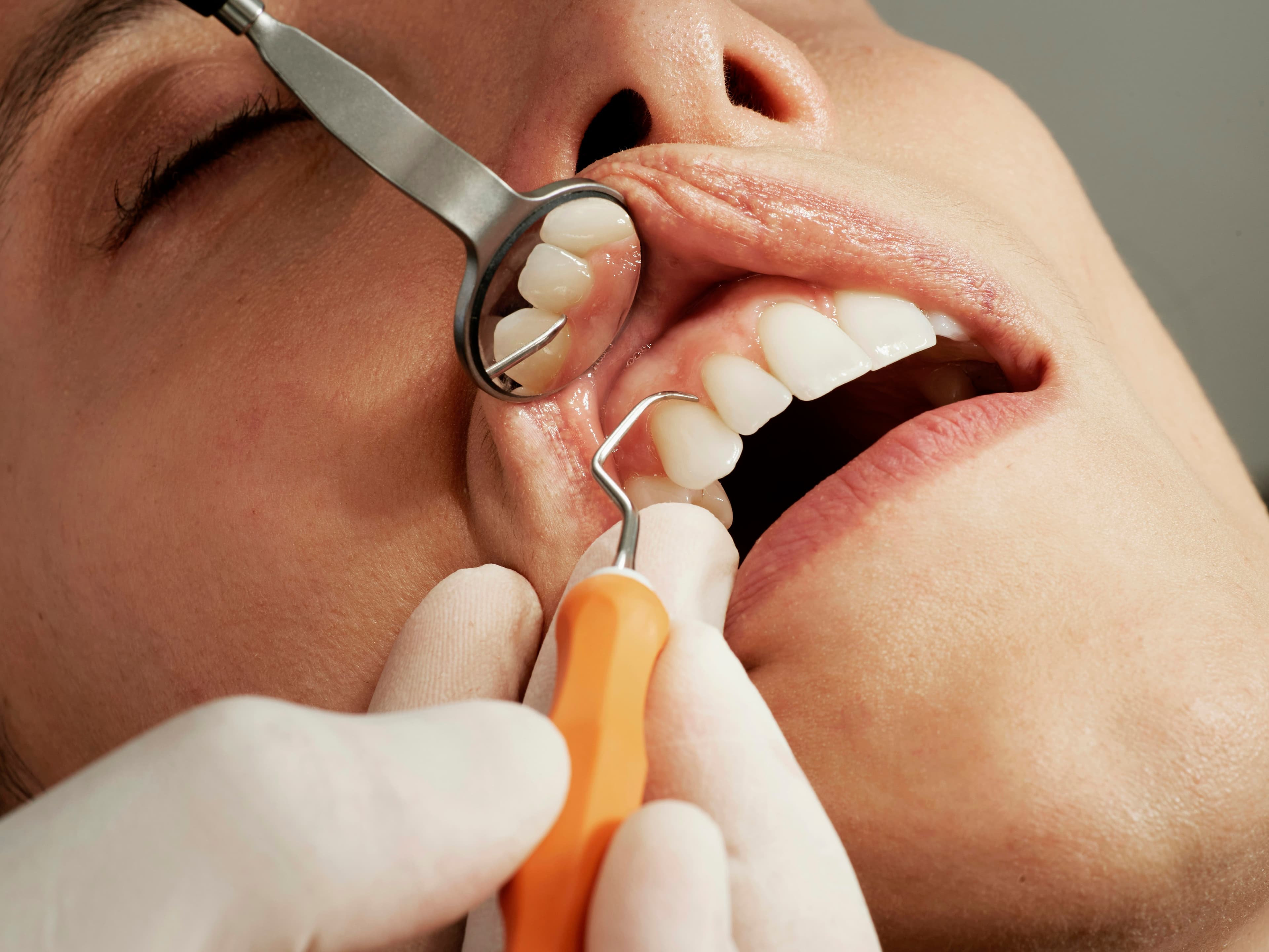 Revisión dental con espejo y explorador.